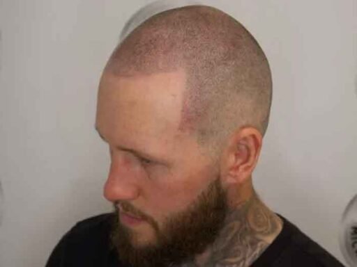 Scalp Tattoos vs. Traditional Hair Restoration Methods