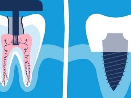 The-Step-by-Step-Process-of-Root-Canal-Therapy-in-Maple-Ridge