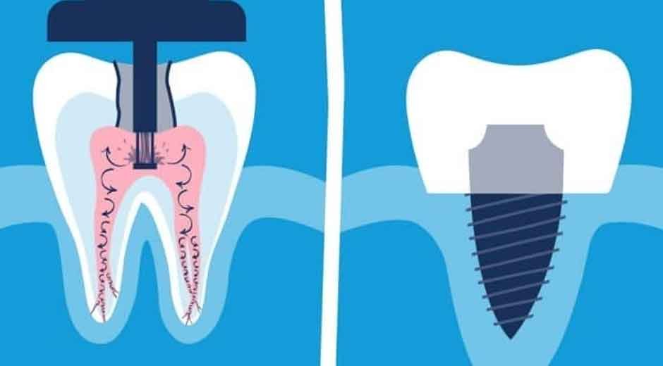 The-Step-by-Step-Process-of-Root-Canal-Therapy-in-Maple-Ridge